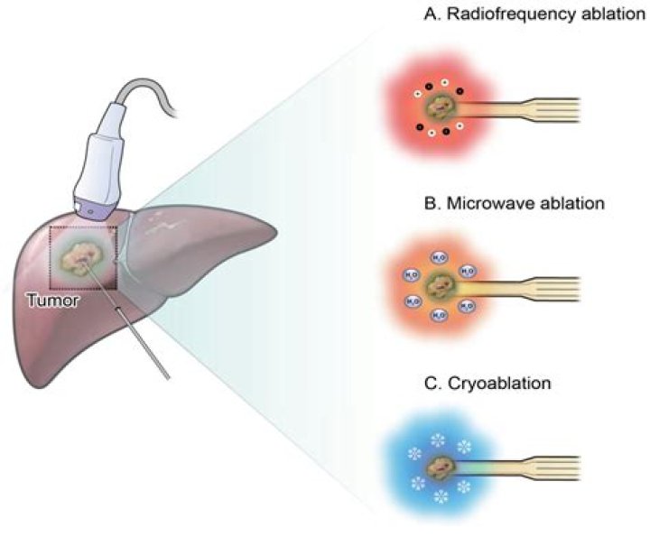 How successful is microwave ablation?